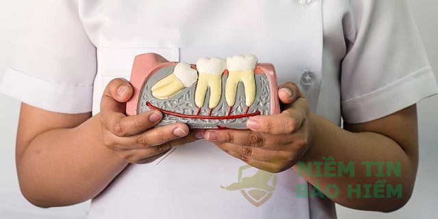 [Giải Đáp] Nhổ răng khôn bảo hiểm y tế có chi trả không? 4