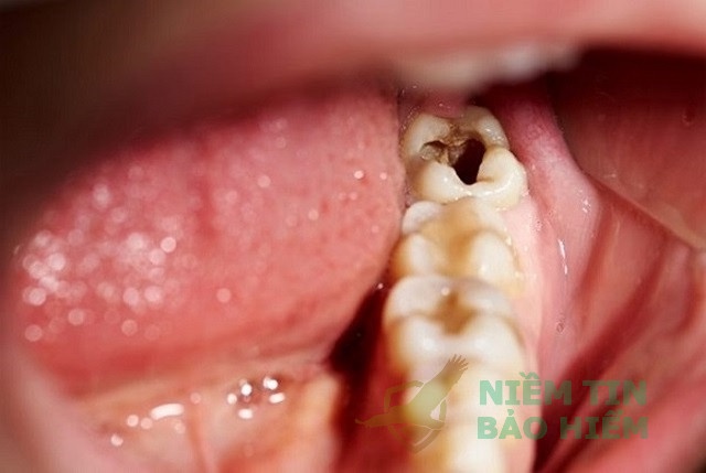 [Giải Đáp] Nhổ răng khôn bảo hiểm y tế có chi trả không? 2