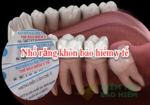 [Giải Đáp] Nhổ răng khôn bảo hiểm y tế có chi trả không? 13